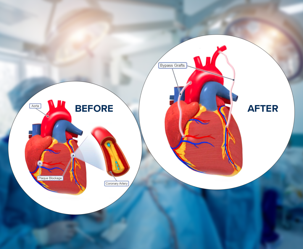 Coronary Artery Bypass Surgery in Chandigarh